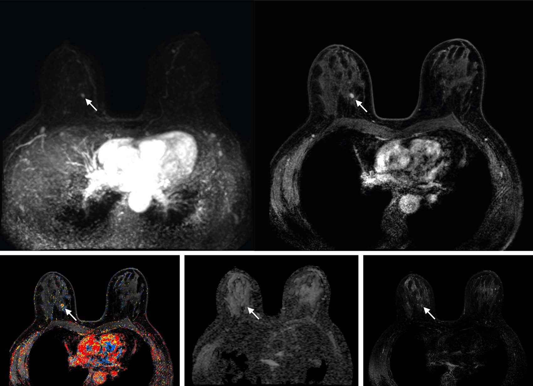 Beelden van een verkorte MRI-scan waarop verdachte cellen te zien zijn.