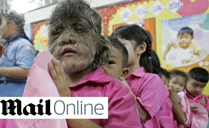 Het Thaise schoolmeisje Supatra Sasuphan met het weerwolfsyndroom.