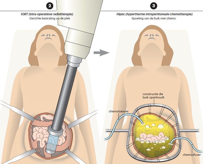 Samen beslissen: eerst chemotherapie of eerst opereren
